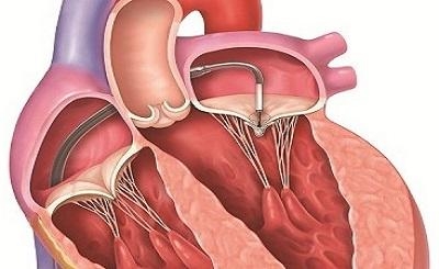 Những điều cần biết về bệnh van tim