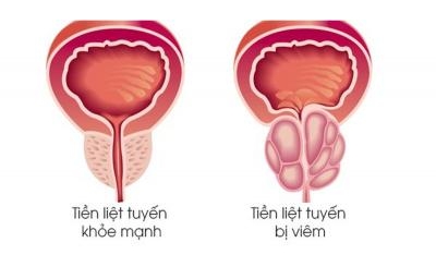 Bệnh viêm tiền liệt tuyến là gì? Viêm tiền liệt tuyến có nguy hiểm không?
