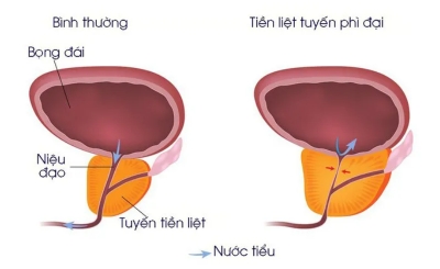 Nam giới bị bệnh tiền liệt tuyến có nên dùng đông trùng hạ thảo không?